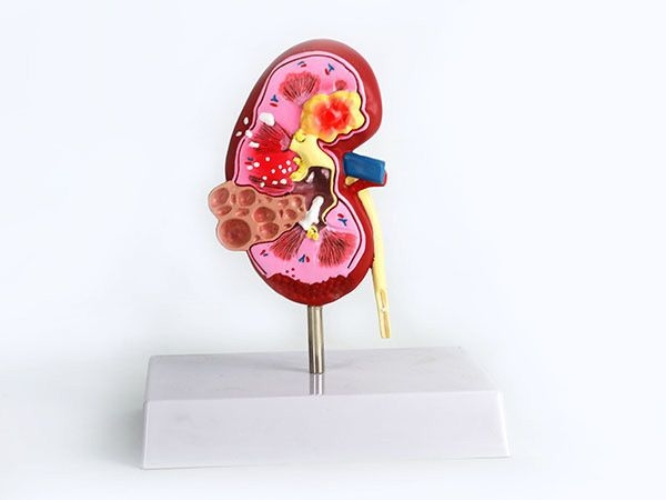 肾单位肾小体模型